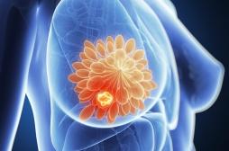 Cancer du sein incurable : un nouveau « médicament intelligent » donne de l'espoir