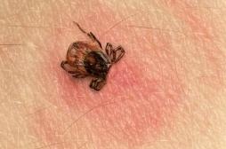 Maladie de Lyme : augmentation de la fréquence des diagnostics en médecine générale