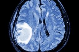 Androcur : les nouveaux patients devront être informés du risque de tumeur au cerveau