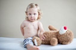 Rougeole : les diagnostics en hausse de 30% dans le monde à cause de l'insuffisance vaccinale