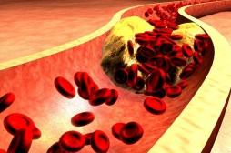 Hypercholestérolémie : traiter fortement le cholestérol ne suffit pas toujours