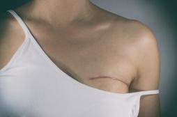 Cancer du sein : cette carence augmente les douleurs post-chirurgicales