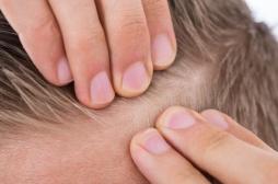 Des scientifiques stimulent la repousse des cheveux sur une peau abîmée