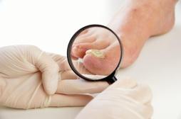 Onychomycose : 4 facteurs augmentant vos risques d'infection fongique des ongles
