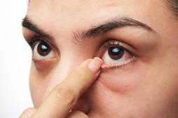 Sécheresse oculaire : le microbiote de vos yeux pourrait jouer un rôle