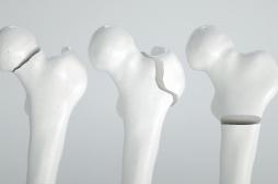Ostéoporose : un médicament contre les fractures protègerait aussi le cœur 