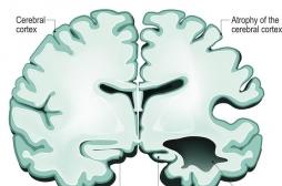 Alzheimer : la maladie s'installe chez les patients beaucoup plus tôt que ce que l'on pensait