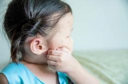 Dengue : l'épidémie se poursuit à La Réunion, 297 nouveaux cas en une semaine