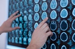 Sclérose en plaques : des anomalies dans la substance blanche du cerveau 
