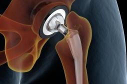 Vers de nouvelles prothèses de hanche