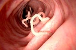 Ces signes qui montrent que vous avez un parasite intestinal