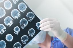Maladie d'Alzheimer : des chercheurs pensent avoir enfin trouvé un traitement