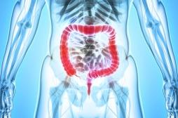 Cancer du côlon : deux additifs alimentaires utilisés comme compléments en fer augmentent les risques