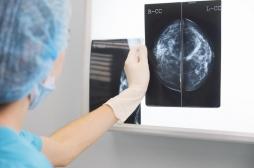Cancer du sein : une nouvelle technique de mammographie pourrait réduire le recours à la biopsie