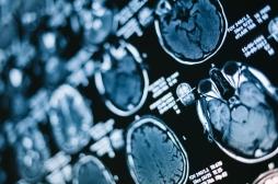 Alzheimer : on en sait plus sur la dégradation de la communication entre les cellules cérébrales