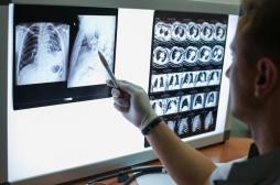 Cancer du poumon : les experts se mobilisent pour un dépistage massif