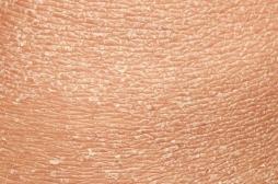 Peau sèche en hiver : 5 conseils pour la protéger et l'hydrater 