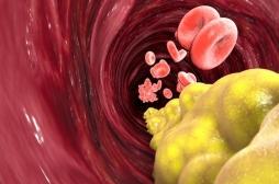 Choléstérol : comment différencier le bon du mauvais ?