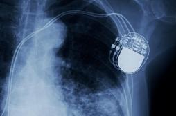 Attente de chirurgie cardiaque :  un stimulateur transitoire qui se dissout sans danger dans le corps