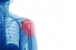 Fracture de l'épaule : porter une simple écharpe donne les mêmes résultats que la chirurgie