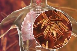 Dreux : un cas de tuberculose détecté au sein du personnel de l'hôpital