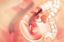 Cancer colorectal : une bactérie buccale pourrait accélérer sa progression