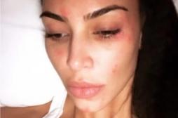 Maladie honteuse : ce qu'il faut savoir sur le psoriasis dont souffre Kim Kardashian
