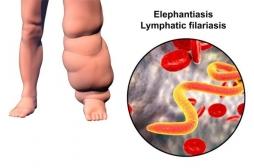 Dans la filariose lymphatique (éléphantiasis), un traitement triple marche dans 100% des cas 