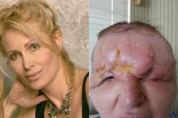  Floride : une femme défigurée après une chirurgie esthétique