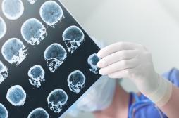 Alzheimer : un déficit d’activité des cellules immunitaires peut expliquer l’apparition de la maladie