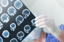 Epilepsie : le traitement par implant ne modifie pas la personnalité 