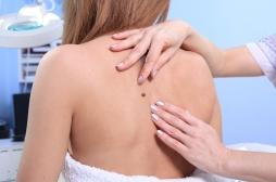 Mélanome : une mutation génétique multiplie le risque par cinq