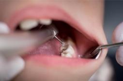 La MIH : une maladie des dents de l’enfant encore méconnue 