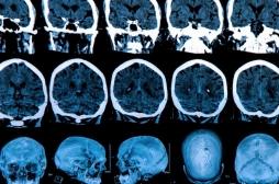 Parkinson : un score pur évaluer le risque de déclin cognitif