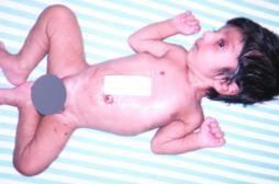 Inde : le bébé né avec 4 jambes opéré avec succès