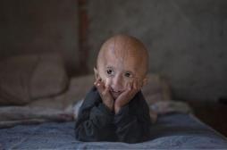 Progéria : des chercheurs freinent le vieillissement accéléré 