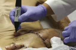 Grâce à une main cousue dans son ventre, Frank Reyes évite l'amputation 