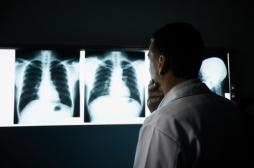Fibrose pulmonaire idiopathique : une maladie rare mais grave