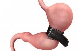 Les adolescents diabétiques et obèses mieux améliorés par la chirurgie bariatrique