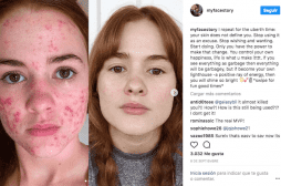 Instagram : un combat contre l’acné inspire des milliers d’ados