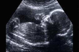 L’IGAS enquête sur la Dépakine 