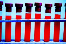 Sida : les vertus insoupçonnées d'un médicament contre l'alcoolisme 