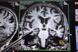 Alzheimer : des spécialistes sur la piste d'une forme de transmission