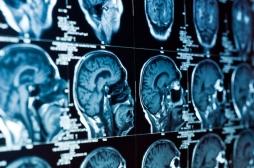 Un homme se fait retirer une énorme tumeur cérébrale de 2 kilos