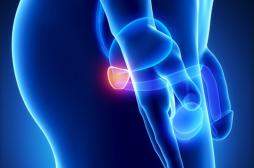 Cancer de la prostate : l’IRM pour éviter des examens invasifs