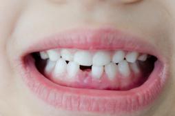 Dentition des enfants : attention aux sports de contact