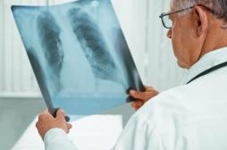 Tuberculose : le dépistage étendu à 800 personnes 