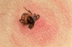 Maladie de Lyme :  150 patients dénoncent un manque de fiabilité des tests 