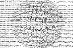 Les traitements modernes contre l’épilepsie ne seraient pas plus efficaces que les anciens