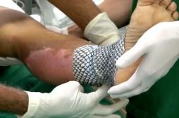 Brûlures : la peau du tilapia cicatrise les plaies à moindre coût
